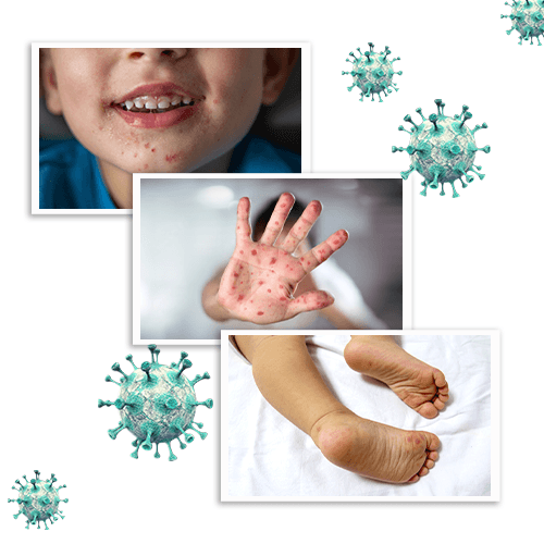 HAND, FOOT & MOUTH DISEASE (HFMD)